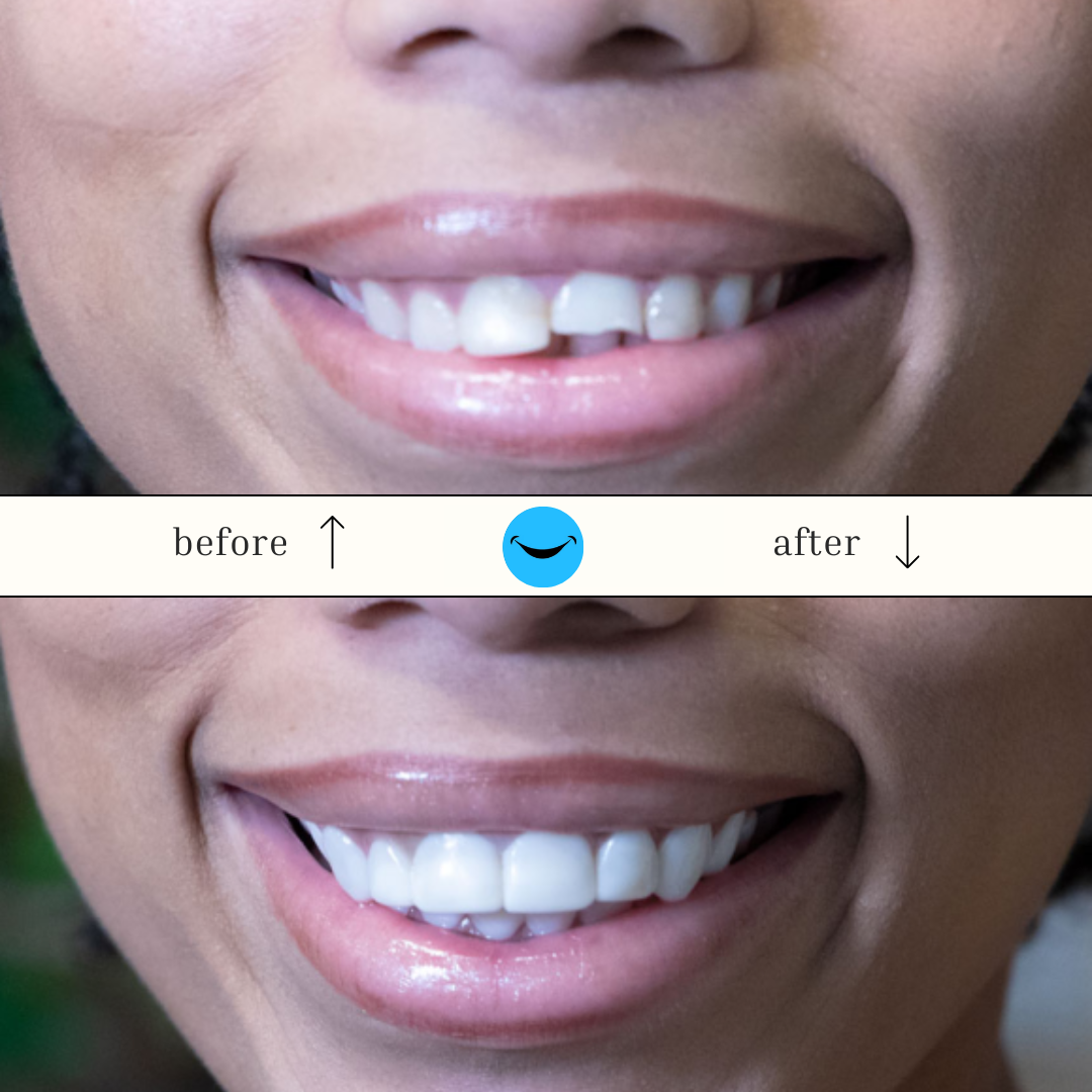 DazzSmile™ Veneers 2.0 - Dazz Smile