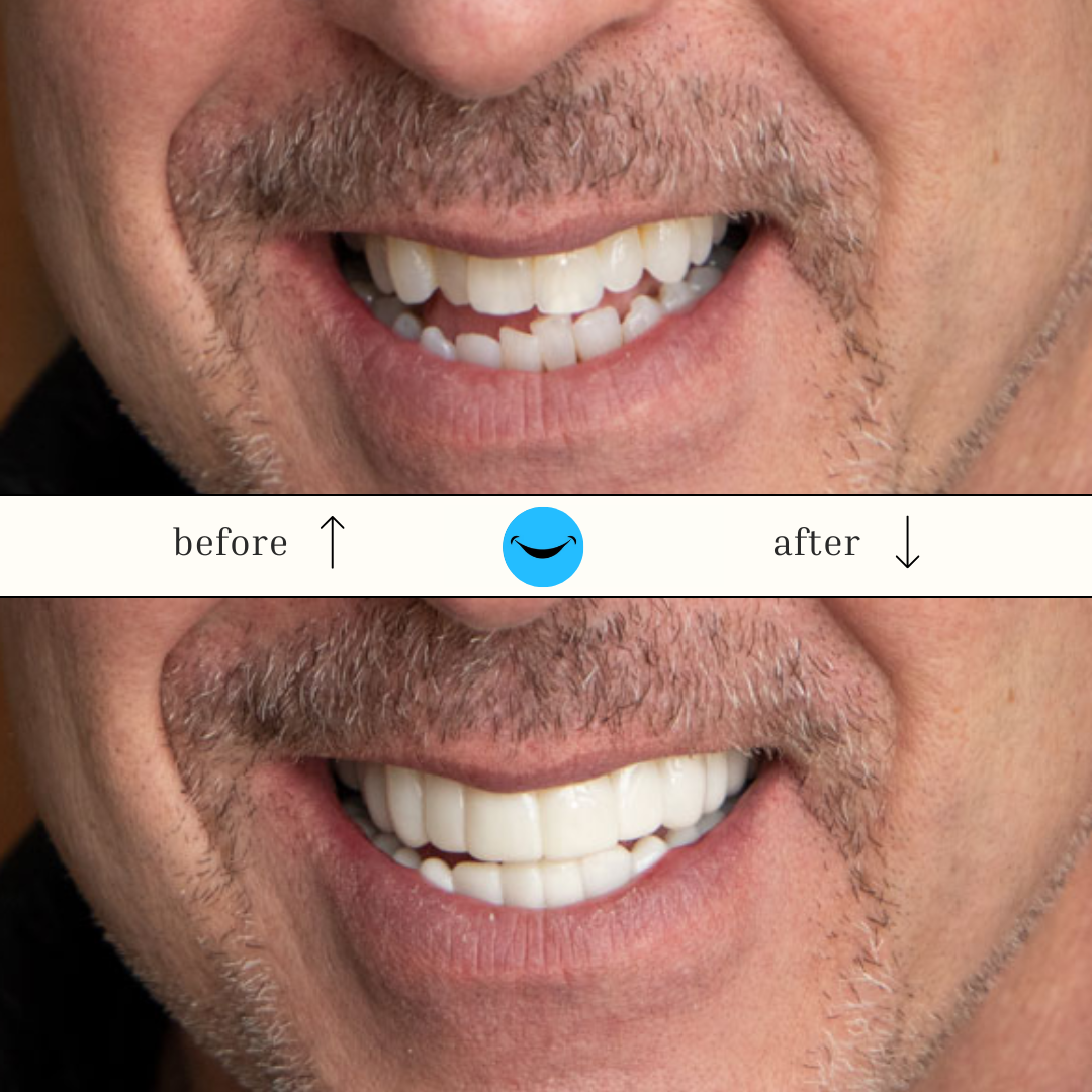 DazzSmile™ Veneers 2.0 - Dazz Smile