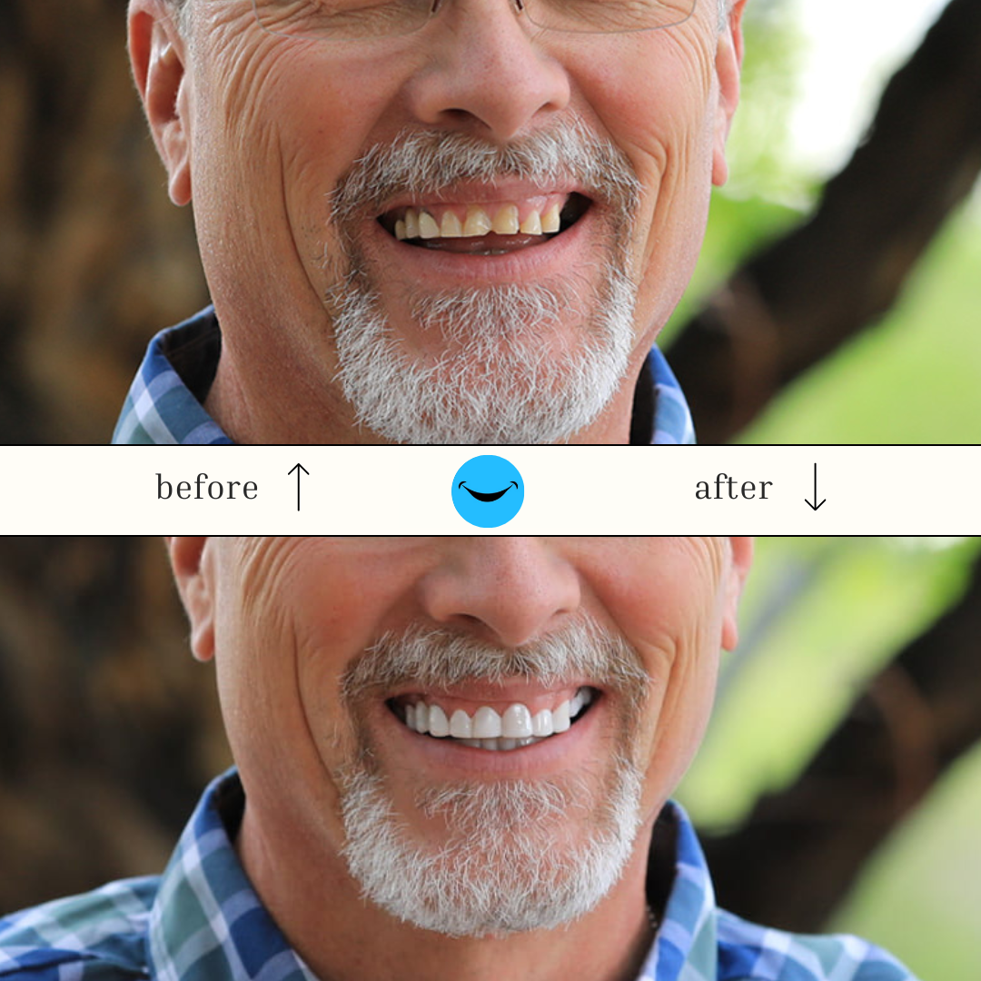 DazzSmile™ Veneers 2.0 - Dazz Smile