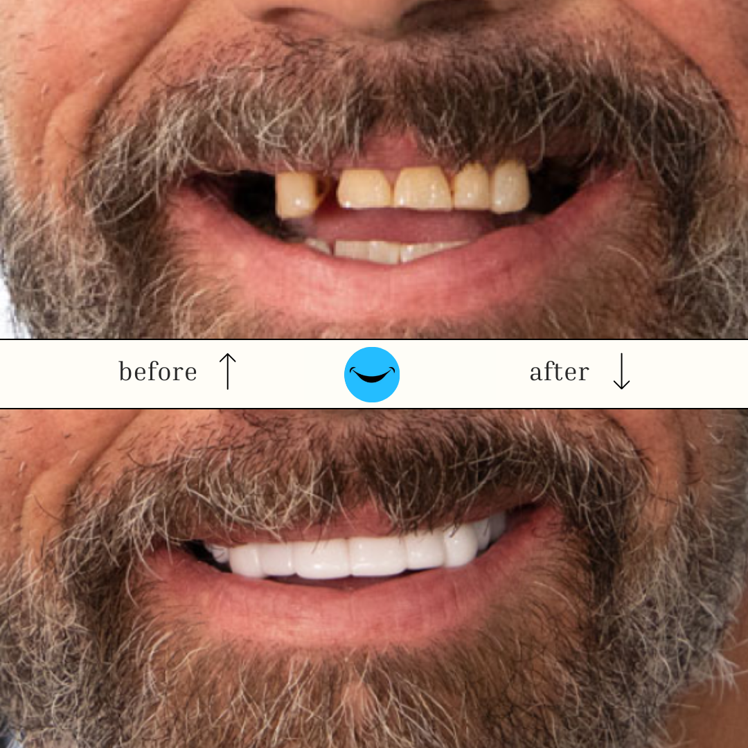 DazzSmile™ Veneers 2.0 - Dazz Smile