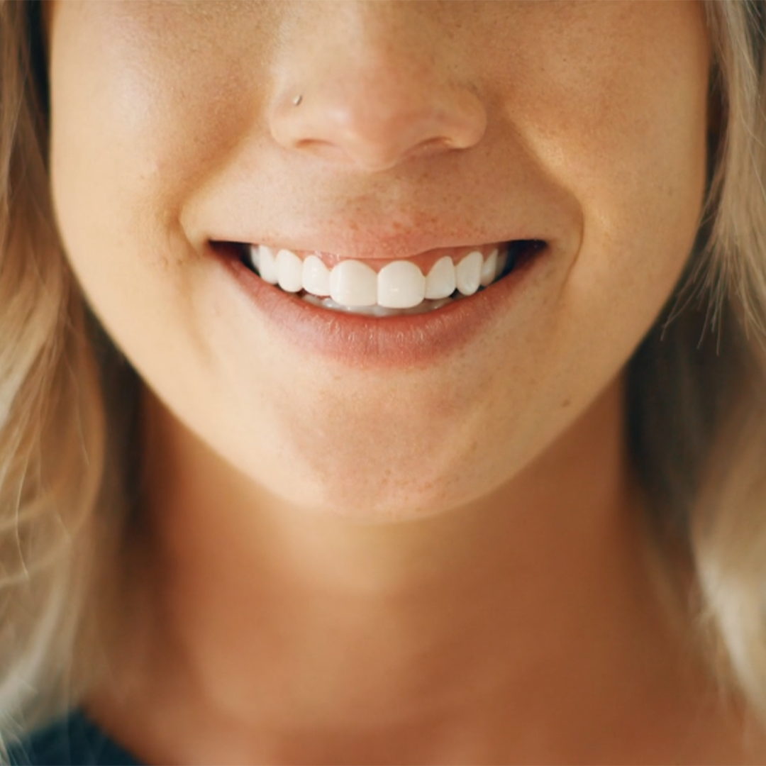 DazzSmile™ Veneers 2.0 - Dazz Smile